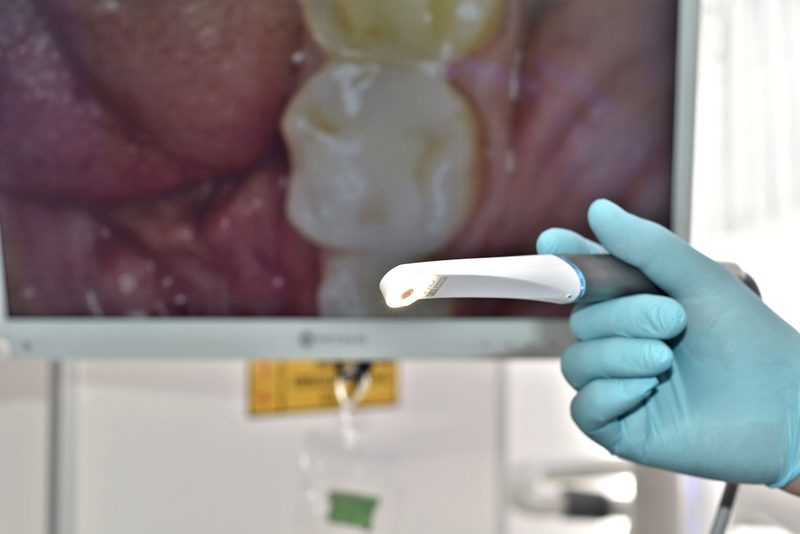 Kamera wewnątrzustna